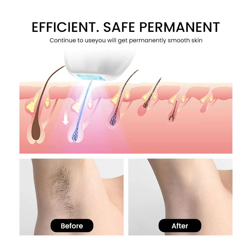 Épilateur laser portable Moolweel T033KW de haute qualité, indolore et permanent, pour une utilisation à domicile.